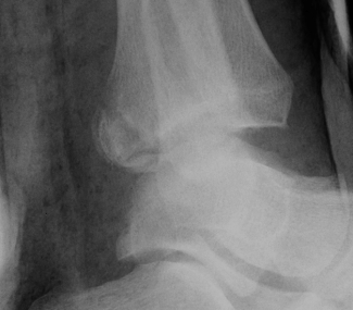 Ankle Fracture Small Posterior Malleolus Xray